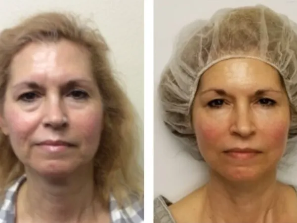 Microcurrent Facial Treatment - before and after, noninvasive facelift