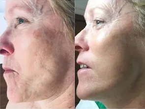 Microcurrent Facial Treatment - before and after, wrinkle reduction