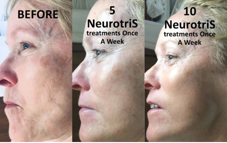 NeurotriS Microcurrent Treatment