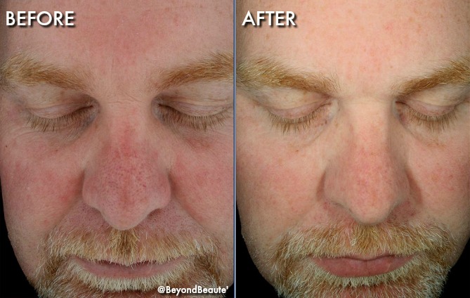 HydraFacial-Sundamage-beforeandafter