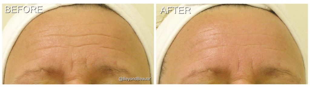HydraFacial™-Facial-Wrinkles-NoDowntime