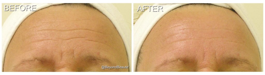 HydraFacial™-Facial-Wrinkles-NoDowntime