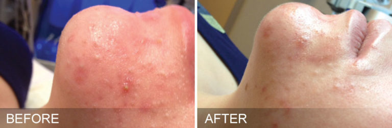 HydraFacial-Hollywood-Skin